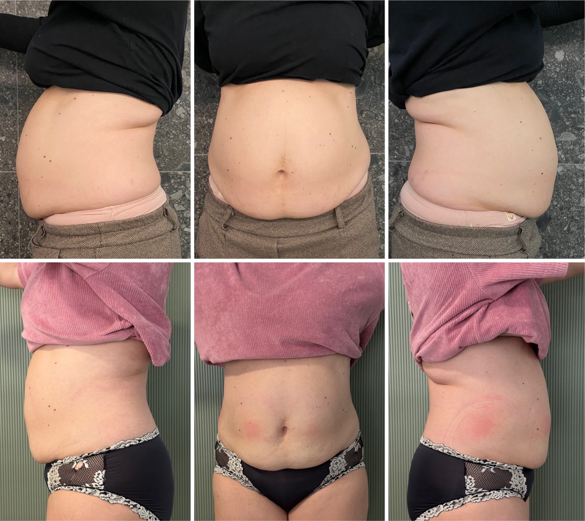 ACRYOS pred a po – výsledok 1