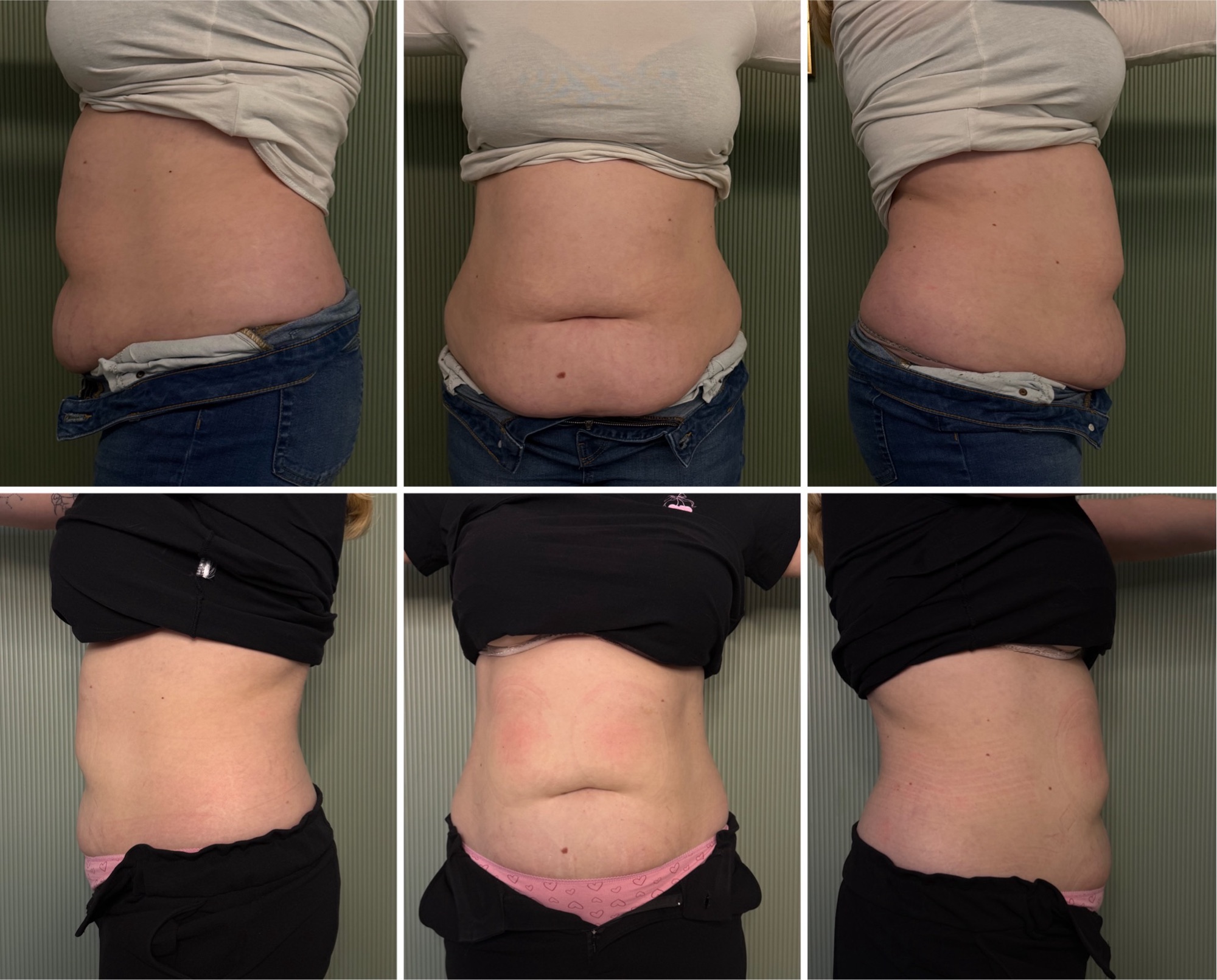 ACRYOS pred a po – výsledok 2