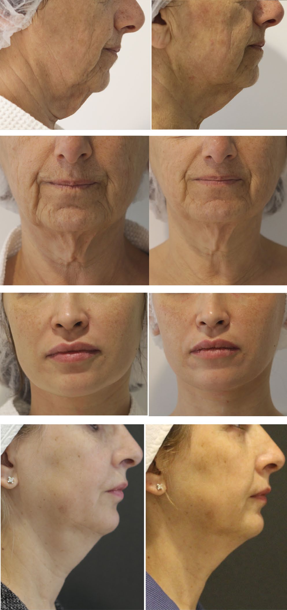 HIFU lifting pred a po — spevnenie línie sánky a kontúry tváre