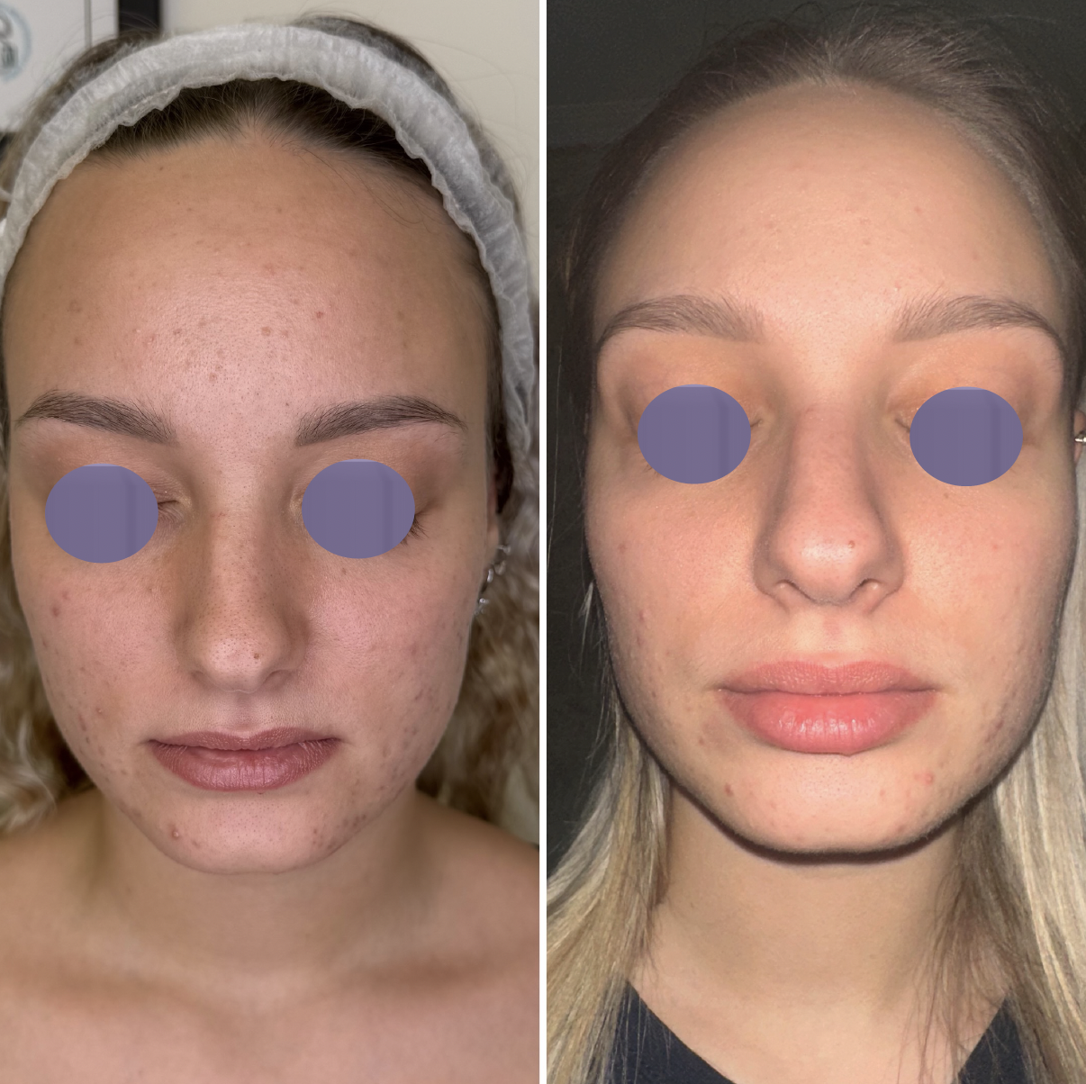 Pleť pred ošetrením Préime DermaFacial a po ňom, rozjasnenie a hydratácia