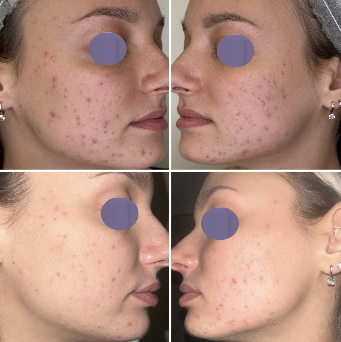 Zmena textúry pleti a pórov po sérii ošetrení Préime DermaFacial