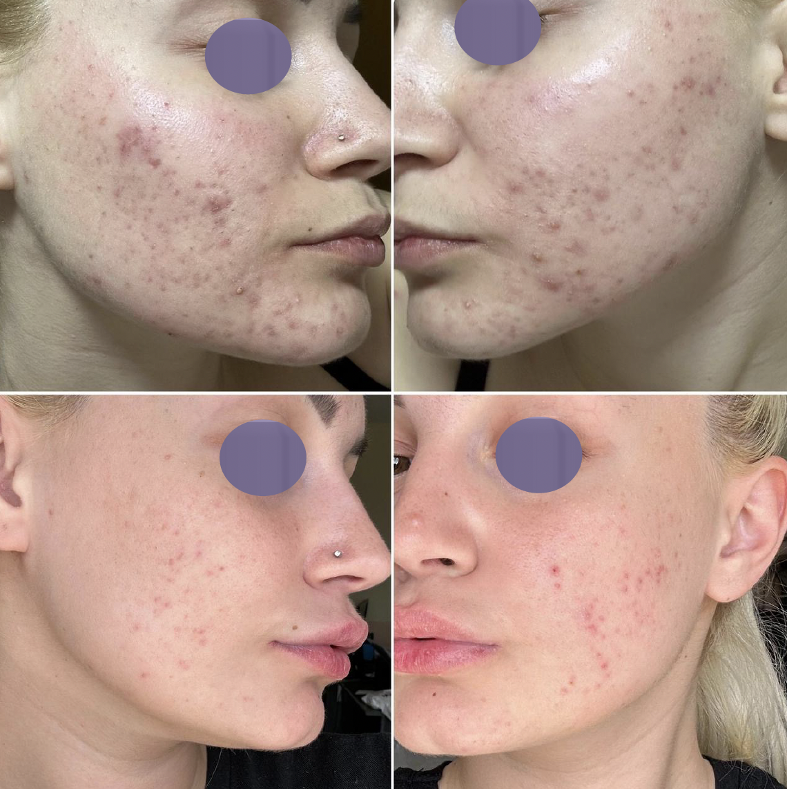 Rozšírené póry pred ošetrením Préime DermaFacial a po ňom