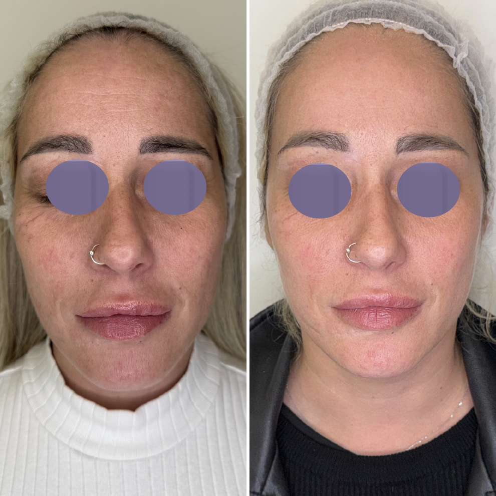 Nerovný tón pleti pred ošetrením Préime DermaFacial a po ňom