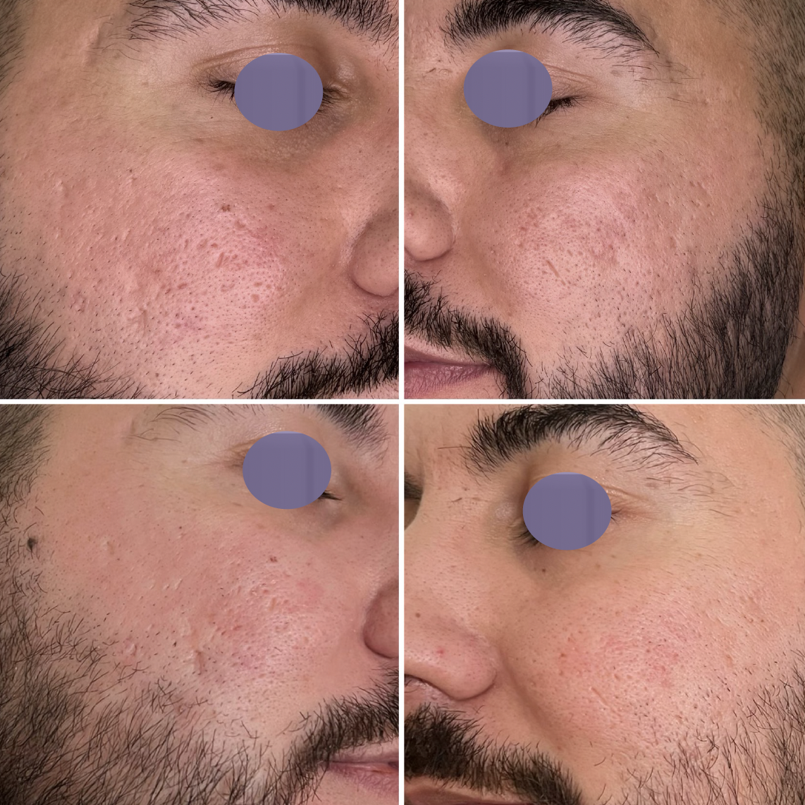 Pleť so sklonom k akné pred ošetrením Préime DermaFacial a po ňom