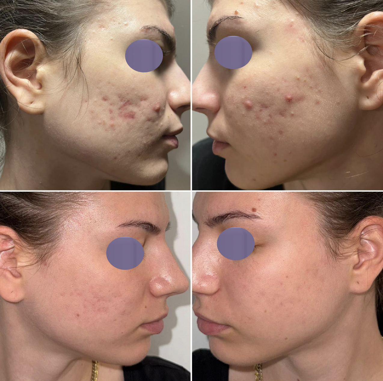 Jemné vrásky pred ošetrením Préime DermaFacial a po ňom