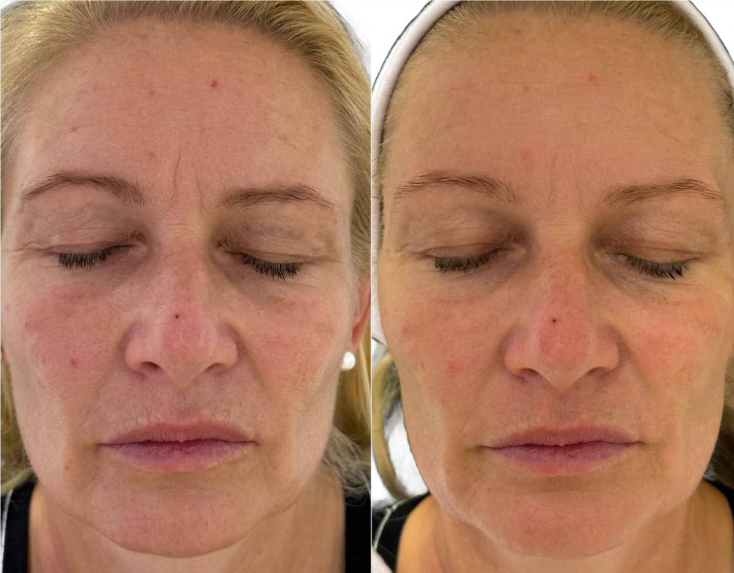 Dehydratovaná pleť pred ošetrením Préime DermaFacial a po ňom