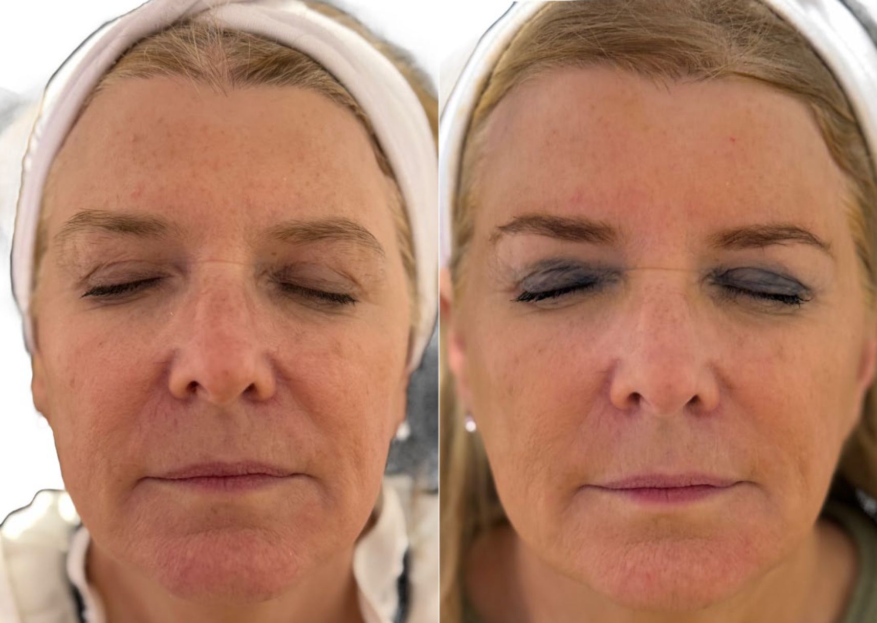Pigmentácie pred ošetrením Préime DermaFacial a po ňom