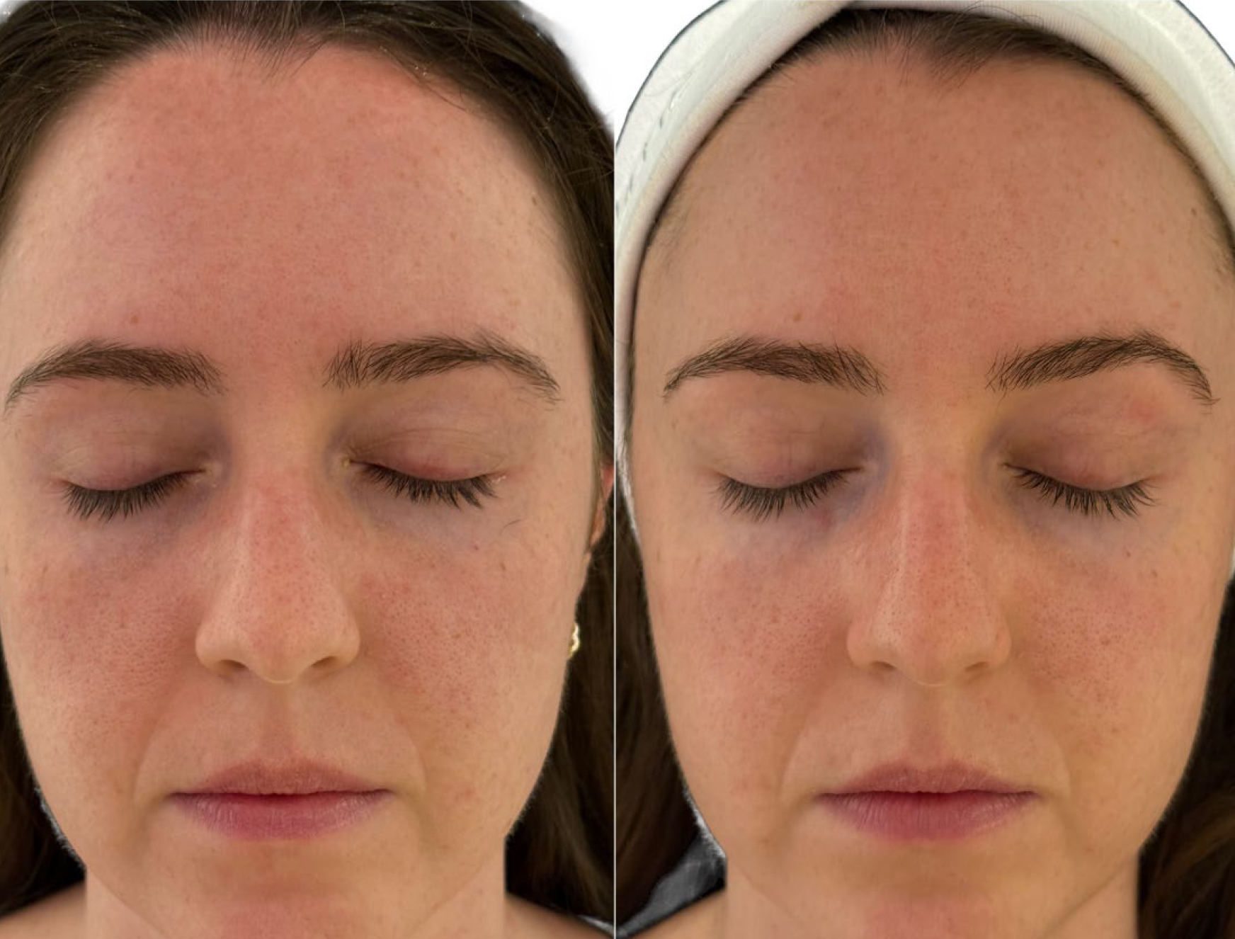 Matná a unavená pleť pred ošetrením Préime DermaFacial a po ňom