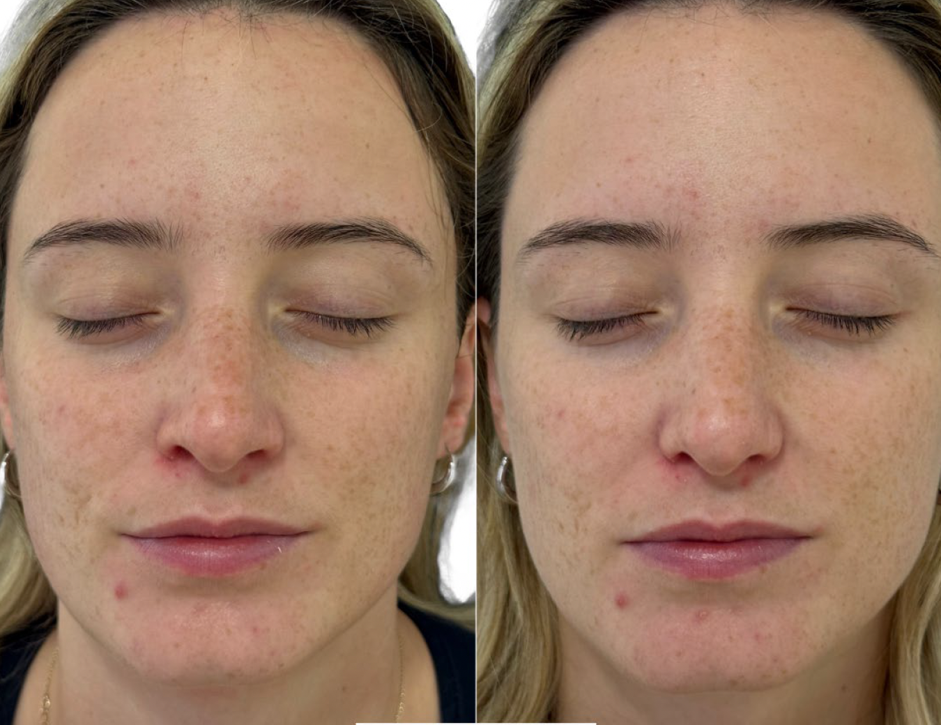 Strata pevnosti pleti pred ošetrením Préime DermaFacial a po ňom
