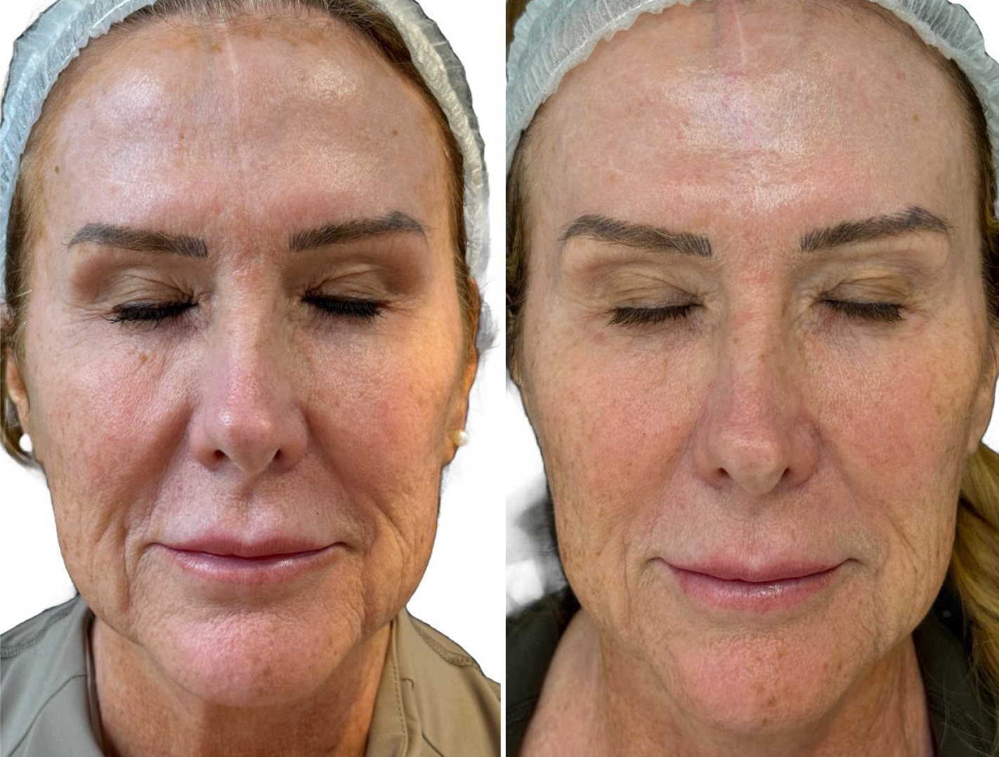 Jazvičky po akné pred ošetrením Préime DermaFacial a po ňom